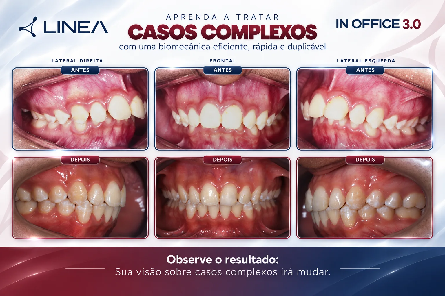 IN OFFICE 3.0: caso complexo tratado com autoligados Linea, fotos de antes e depois nas vistas lateral direita, frontal e lateral esquerda. Observe o resultado: sua visão sobre casos complexos irá mudar.