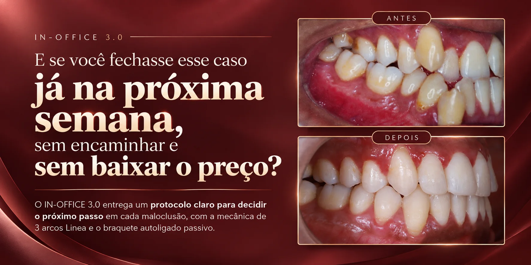 IN-OFFICE 3.0: E se você fechasse esse caso já na próxima semana, sem encaminhar e sem baixar o preço? Caso clínico com fotos de antes e depois.